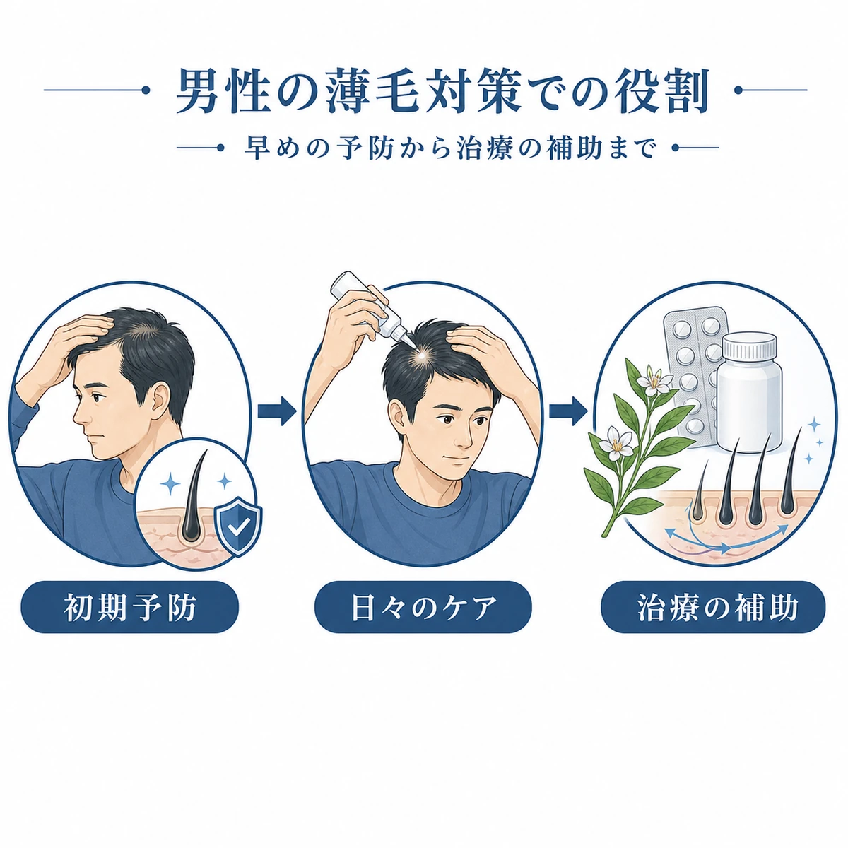 初期予防から治療の補助まで男性の薄毛対策でセンブリエキスが担う役割の流れを表した医療イラスト