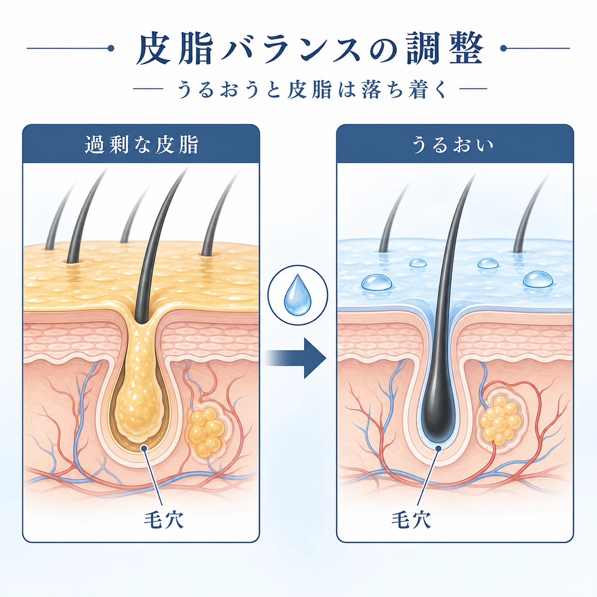 過剰な皮脂からうるおう頭皮へと整う毛穴の変化を表した医療イラスト