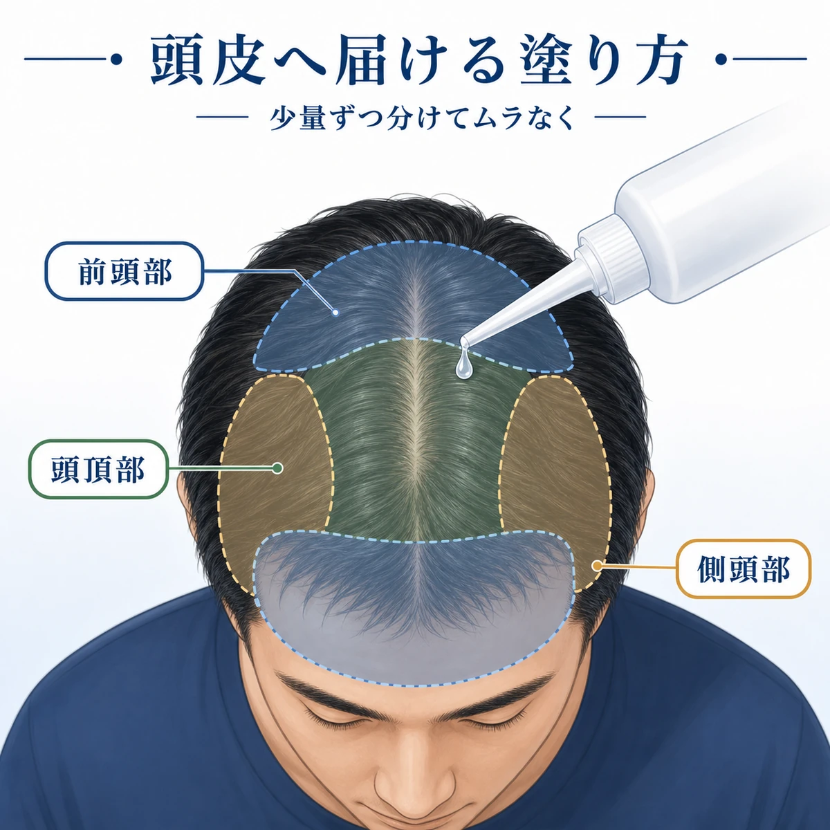 頭部を上から見て育毛剤を各部位に塗り分ける塗布のコツを表した医療イラスト