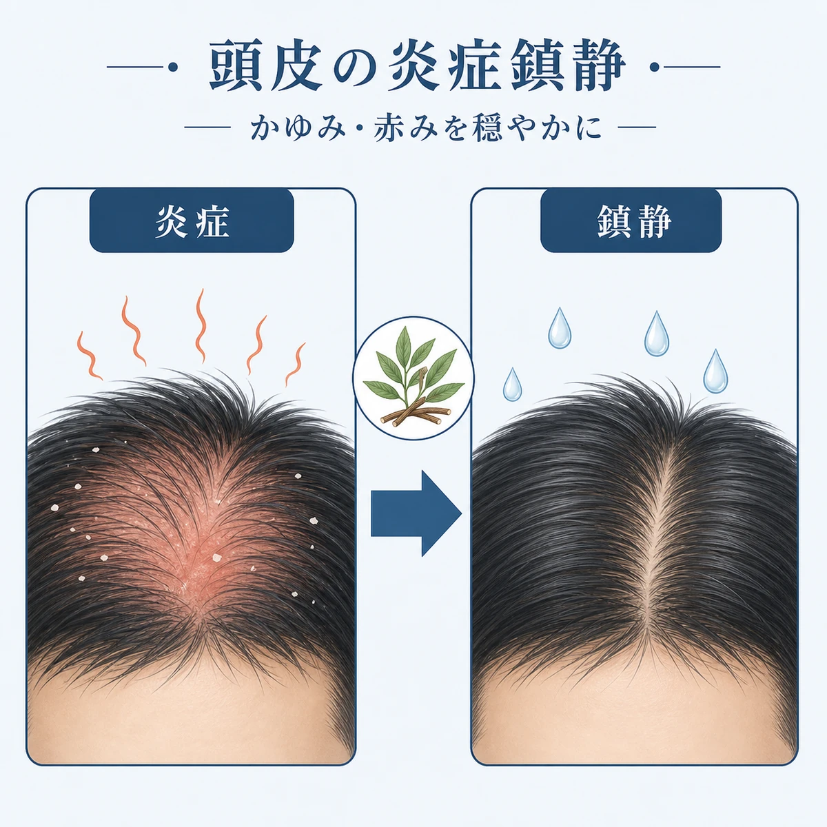 グリチルリチン酸2Kが頭皮の炎症を穏やかに鎮めるはたらきを表した医療イラスト