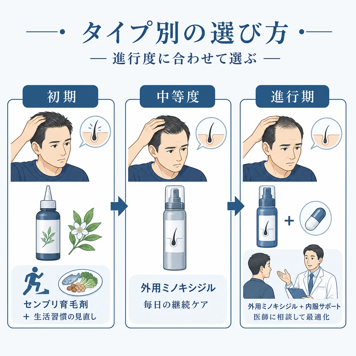 薄毛の進行度に応じてセンブリエキスからミノキシジルへ切り替える段階的な選び方を示した医療イラスト