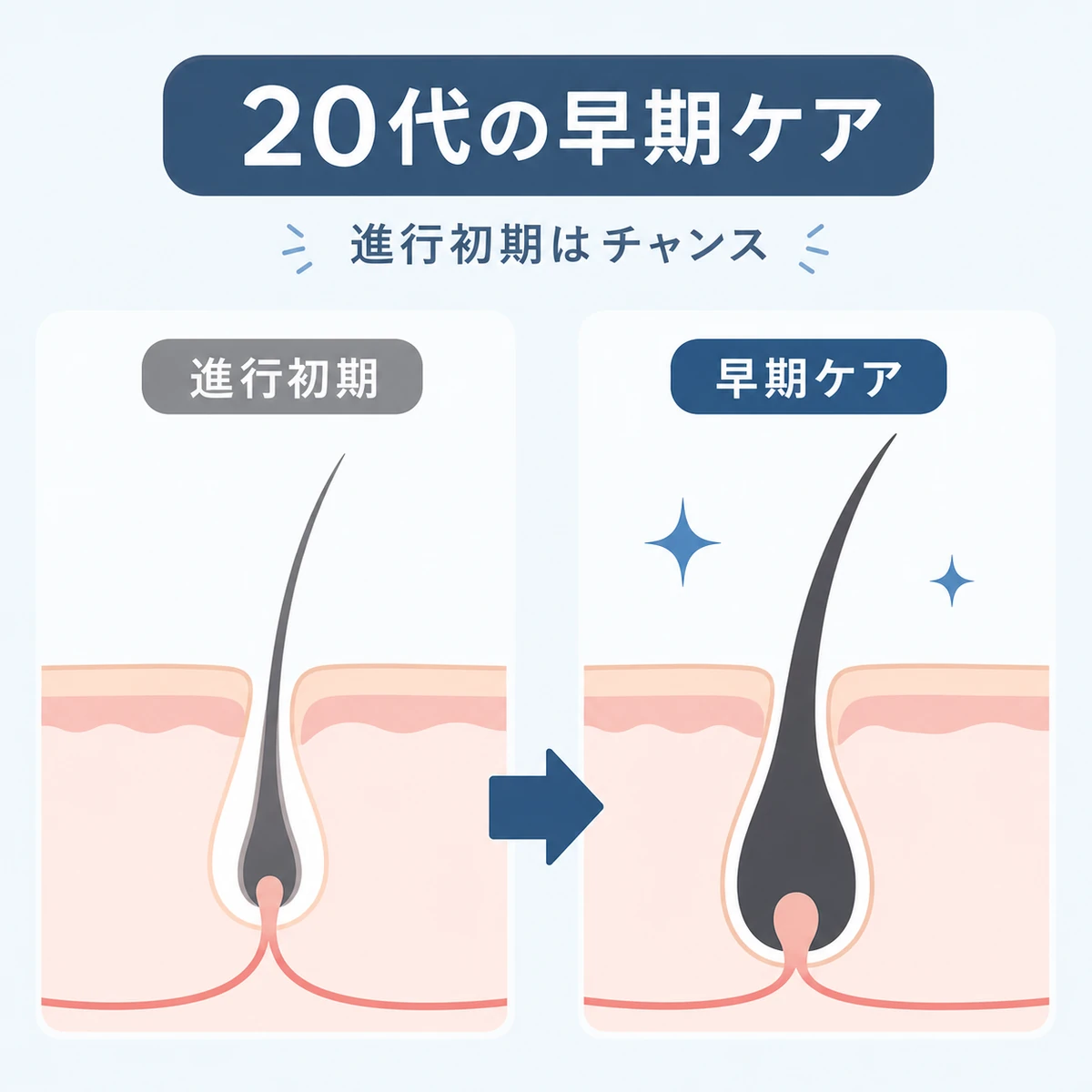20代の進行初期に早期ケアで毛包の状態を保つ変化を表した医療イラスト