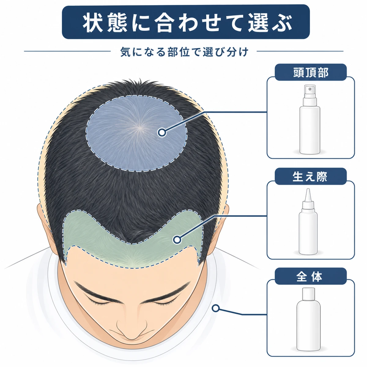 生え際や頭頂部など薄毛の部位ごとに合う製品タイプを頭部の俯瞰マップで表した医療イラスト