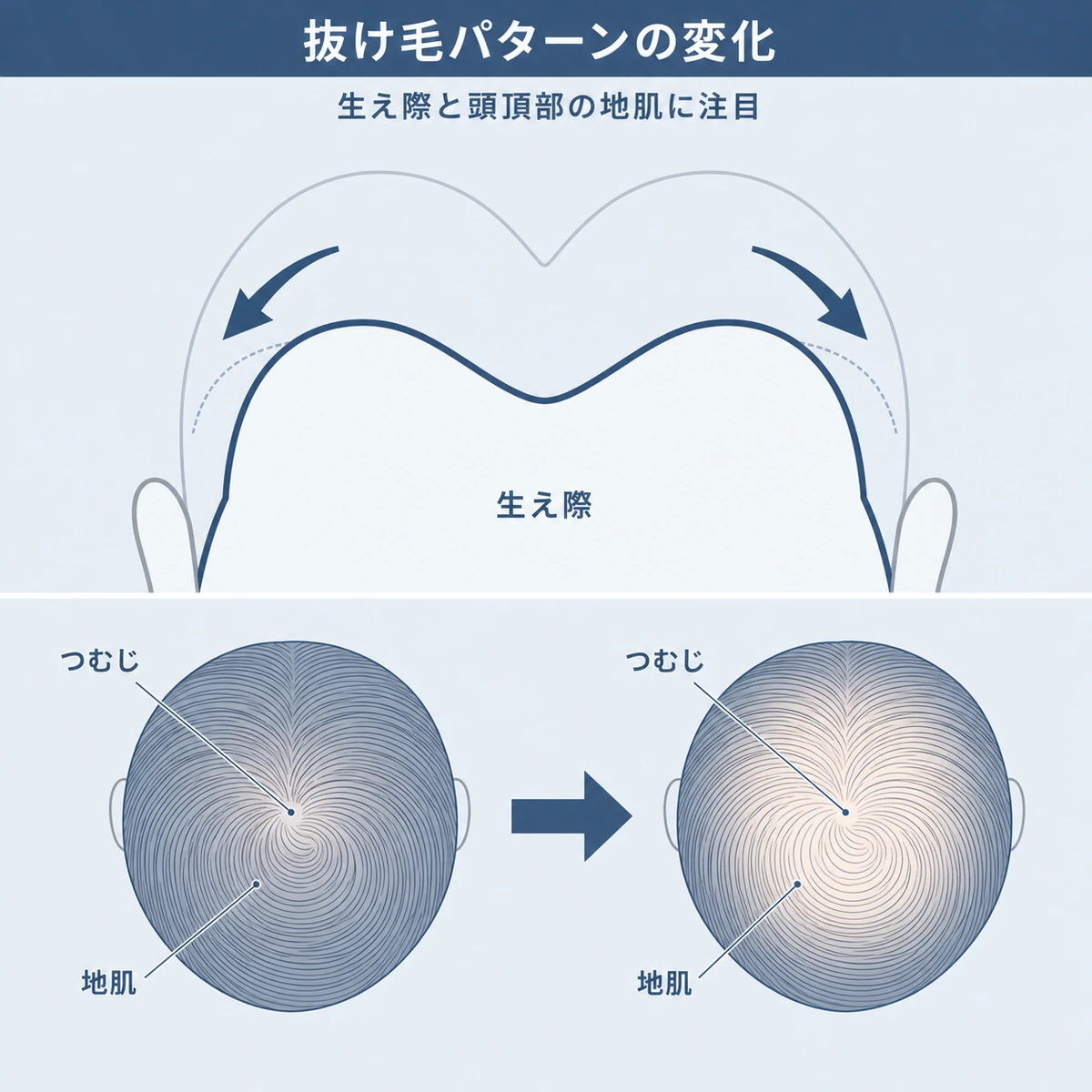 生え際のM字後退と頭頂部の地肌が広がる抜け毛パターンを対比で表した医療イラスト