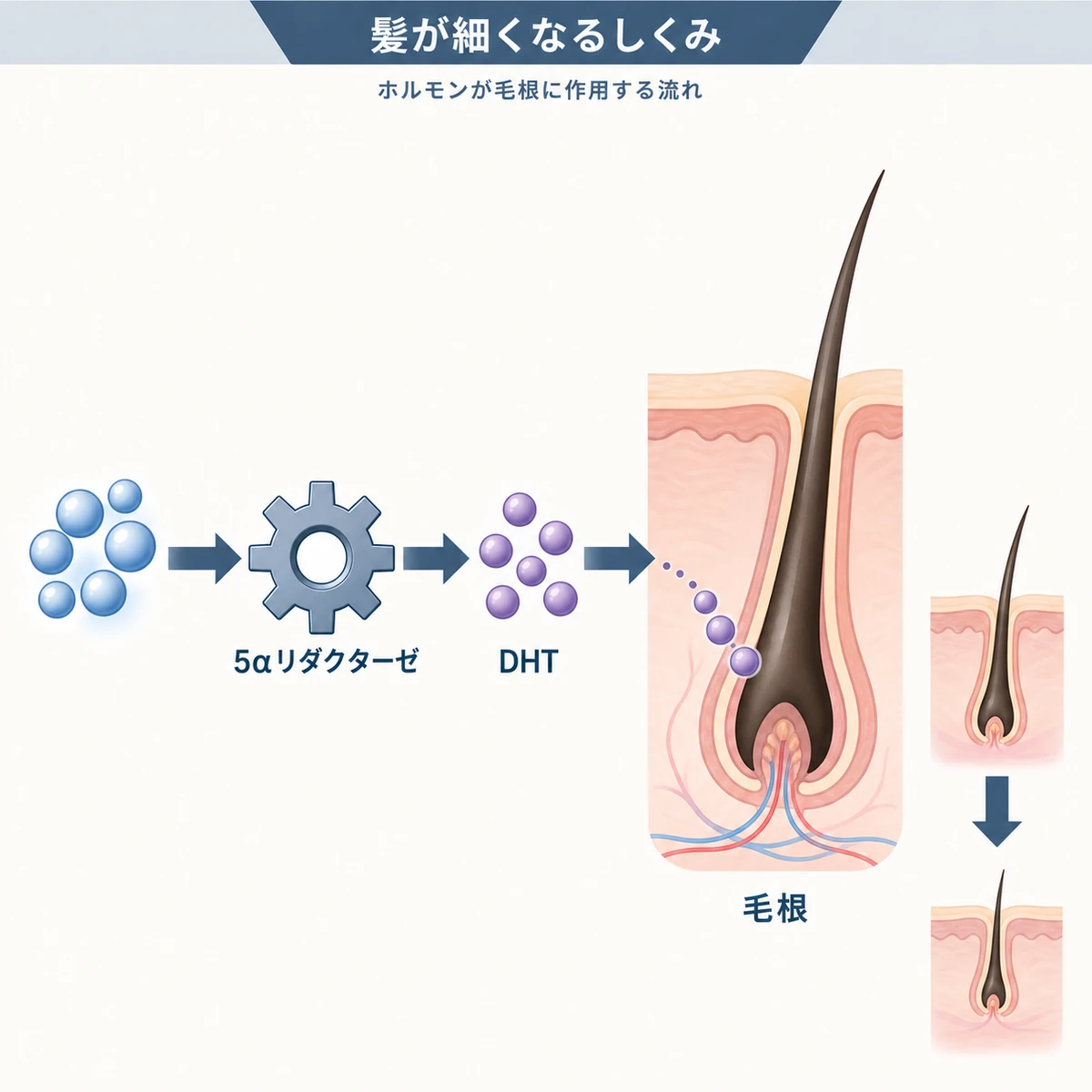 テストステロンがDHTへ変換され毛根に作用して髪が細くなるしくみを表した医療イラスト
