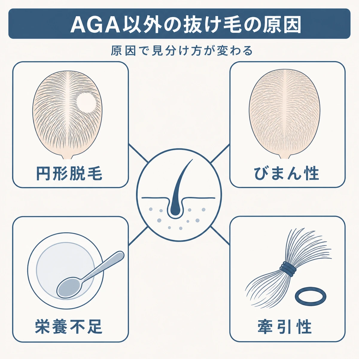 円形脱毛症やびまん性脱毛症・栄養不足・牽引性脱毛などAGA以外の抜け毛の原因を分類した医療イラスト