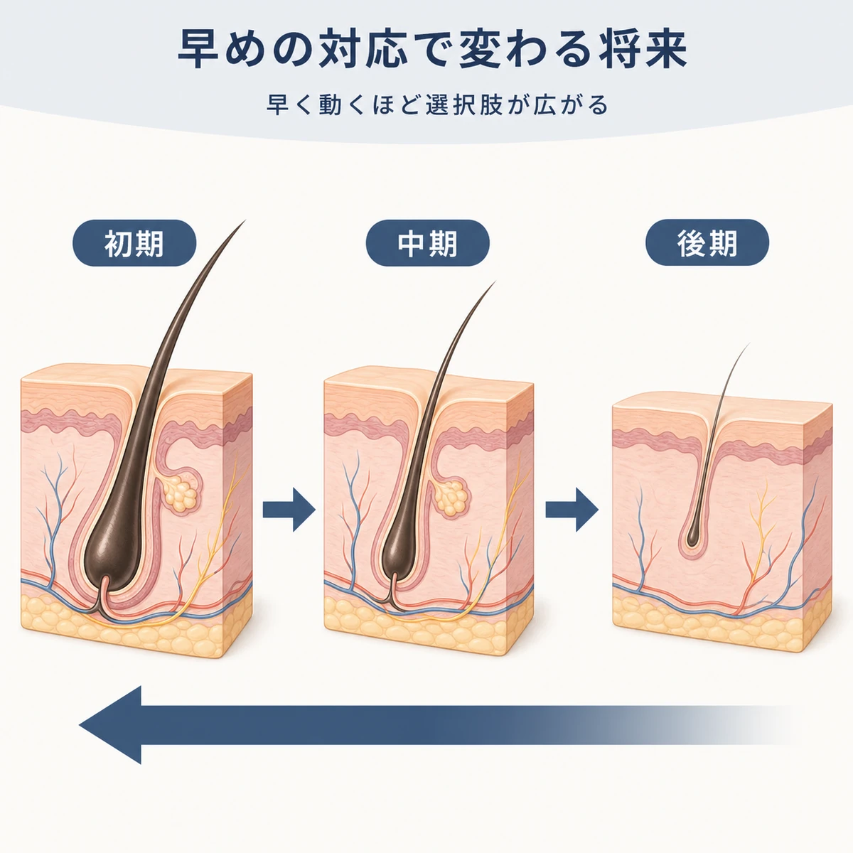 毛包が初期から後期へ萎縮する段階と早めの対応の大切さを表した医療イラスト