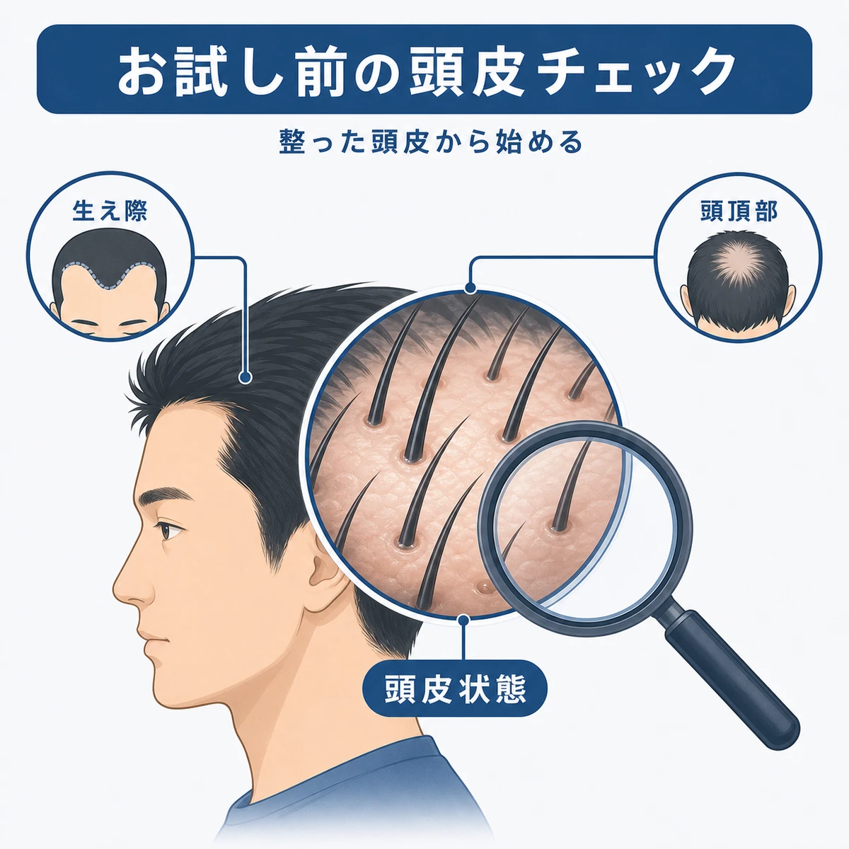 お試し前に確認したい頭皮の状態と生え際や頭頂部の薄毛パターンを表した医療イラスト