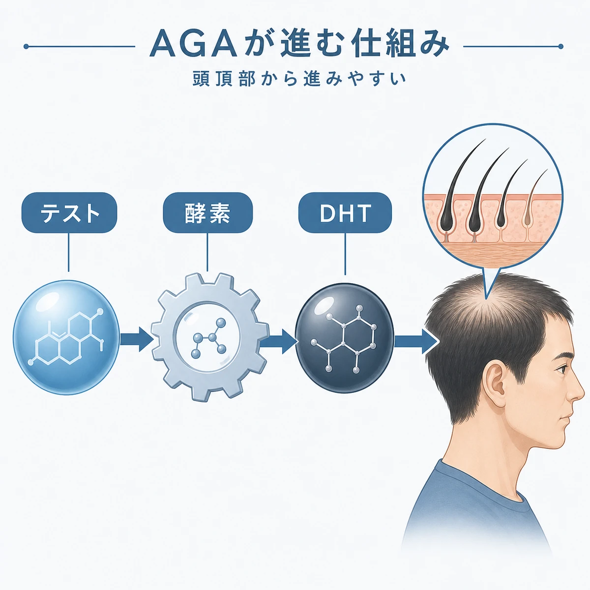 男性ホルモンDHTが頭頂部の薄毛を進行させる仕組みを示した医療イラスト