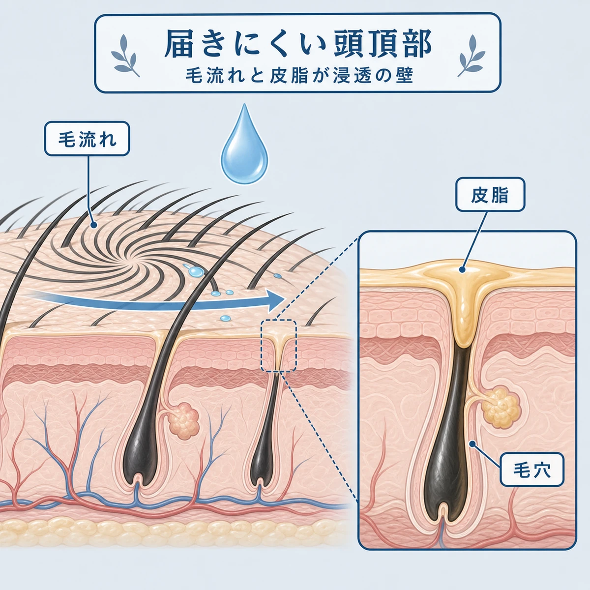 つむじの毛流れと皮脂で育毛剤が浸透しにくい頭皮の断面を表した医療イラスト