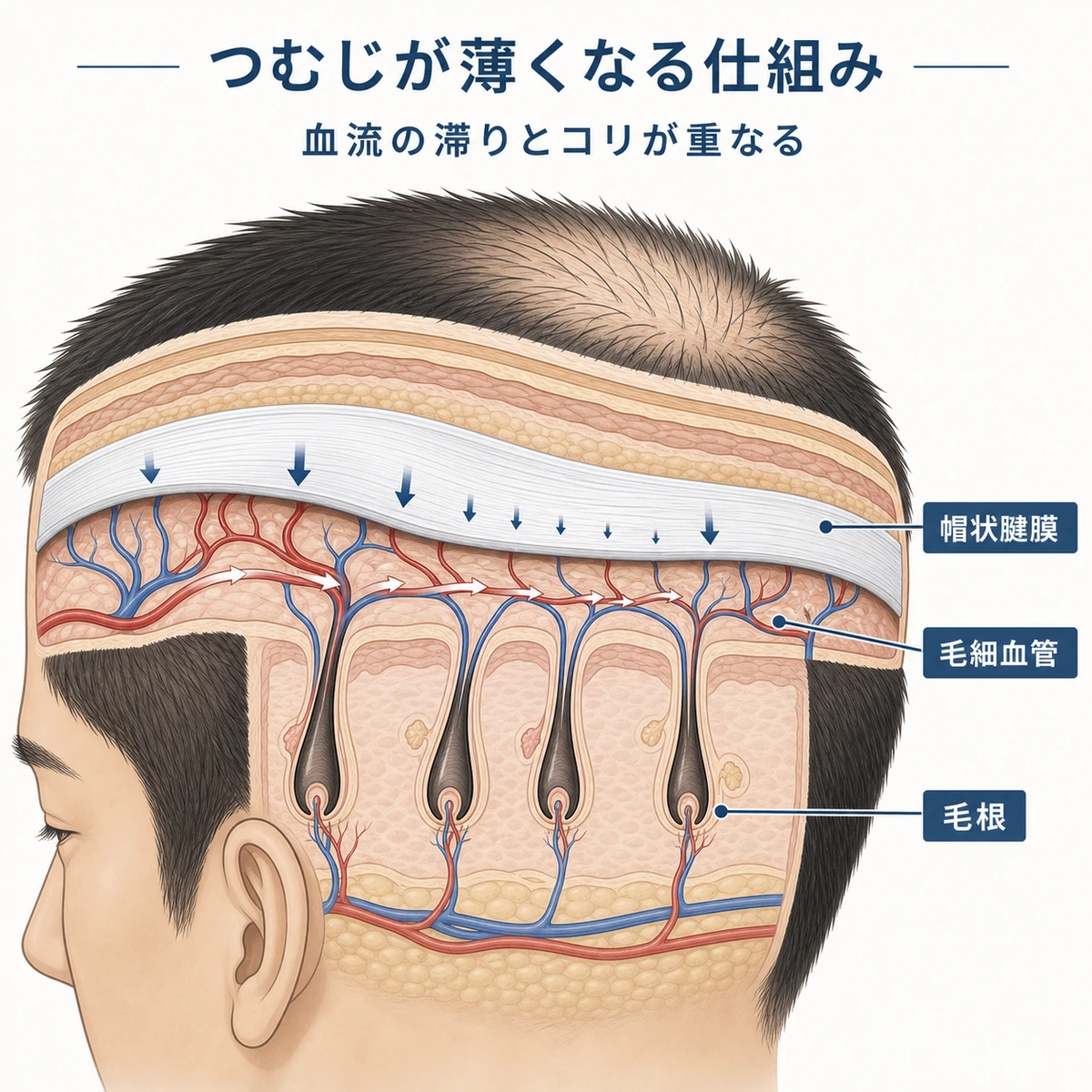 つむじ付近の頭皮で帽状腱膜のコリが毛細血管を圧迫し血流が滞る仕組みを表した断面イラスト