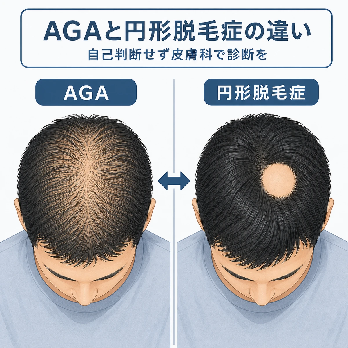 AGAと円形脱毛症の脱毛の違いを頭頂部の俯瞰図で左右に比べた医療イラスト
