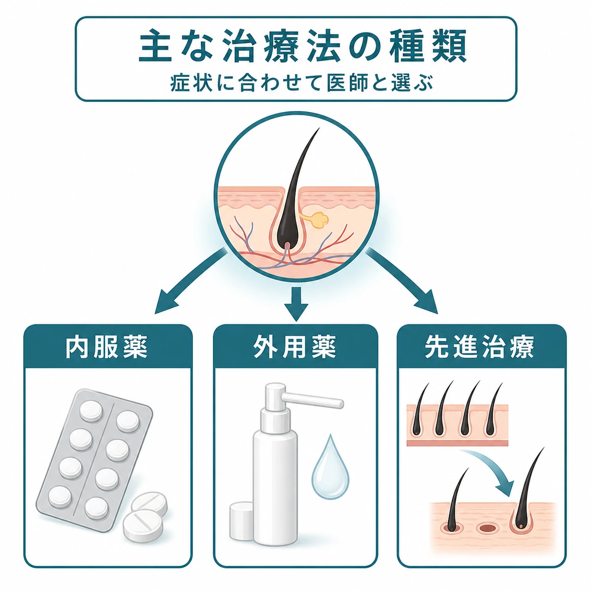 内服薬と外用薬と先進治療というつむじはげの治療法を3つに分類した医療イラスト