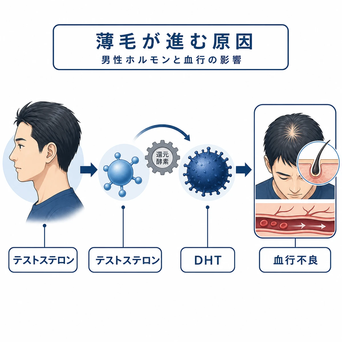 男性ホルモンと血行不良がつむじの薄毛を進める仕組みを表した医療イラスト