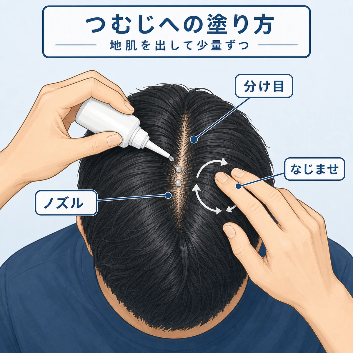 頭頂部を真上から見て分け目を作り育毛剤を塗る手順を表した医療イラスト