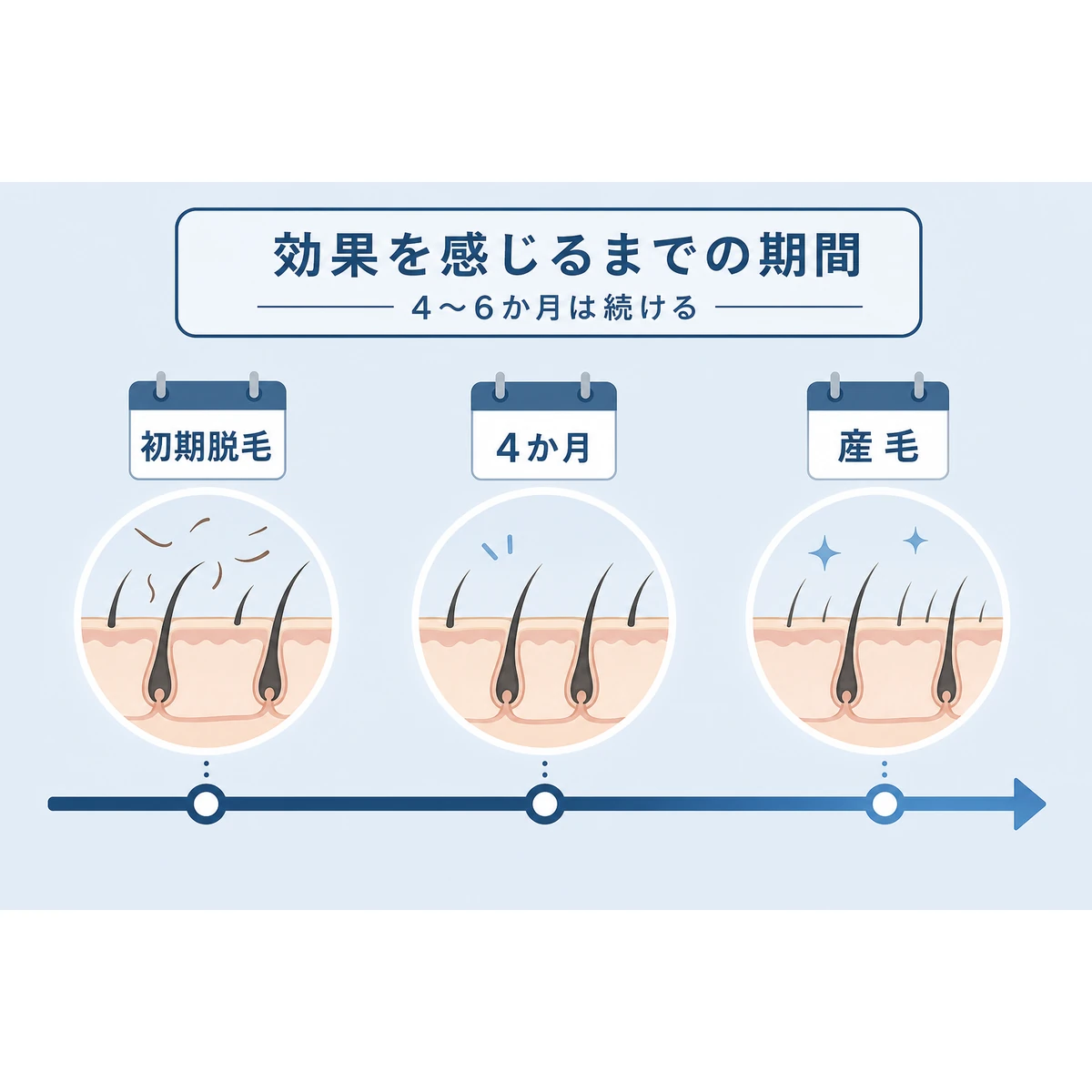 育毛剤の使用期間ごとに現れる変化の目安を横のタイムラインで表した医療イラスト