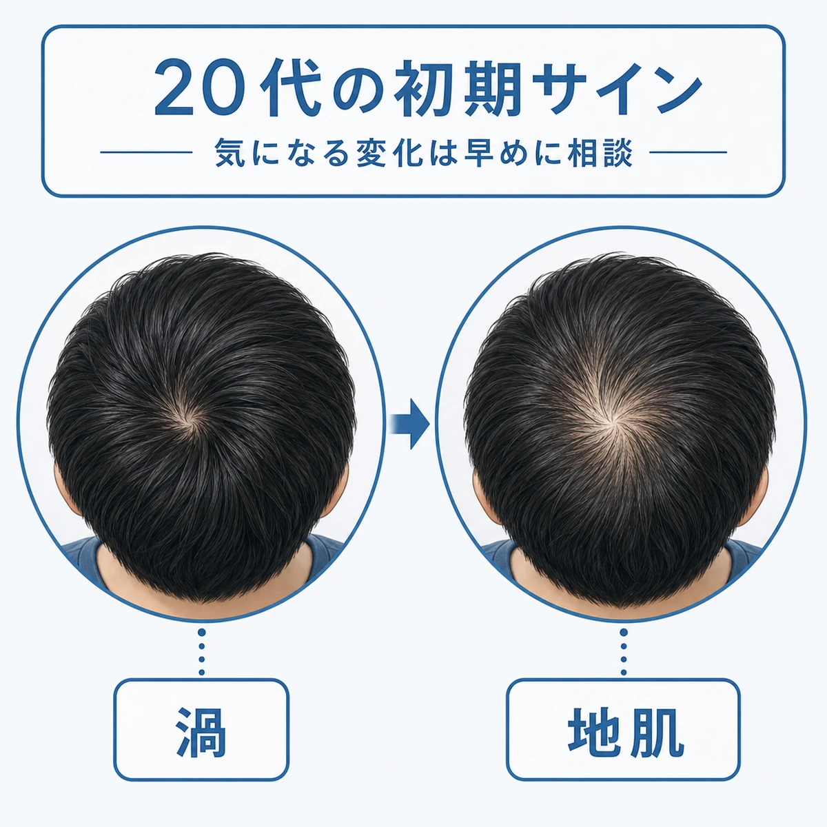 20代のつむじの状態を正常時と初期サインで見比べた医療イラスト
