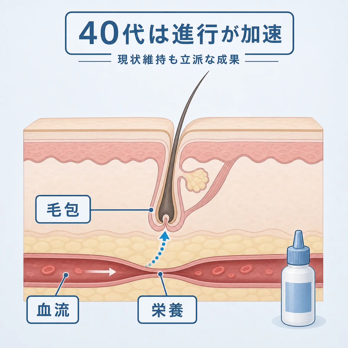 40代で血流の低下と毛包の老化が重なり薄毛が加速するしくみを表した医療イラスト