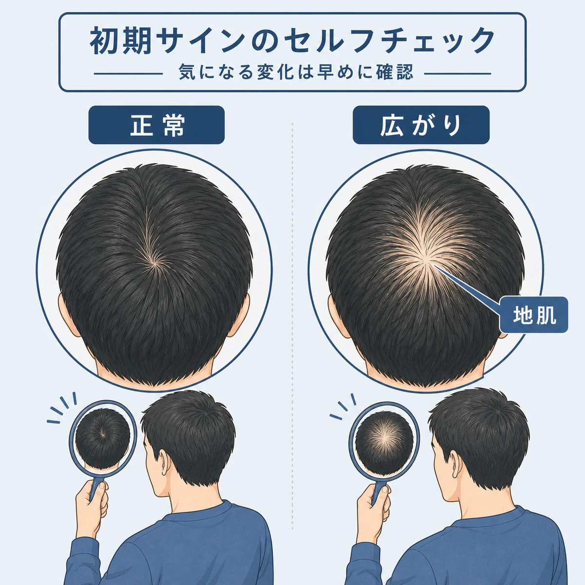 正常なつむじと薄毛が進んだつむじを見分けるセルフチェックを表した医療イラスト
