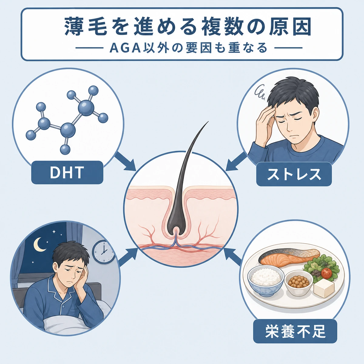 頭頂部の薄毛を進めるAGAや生活要因の関係を表した医療イラスト
