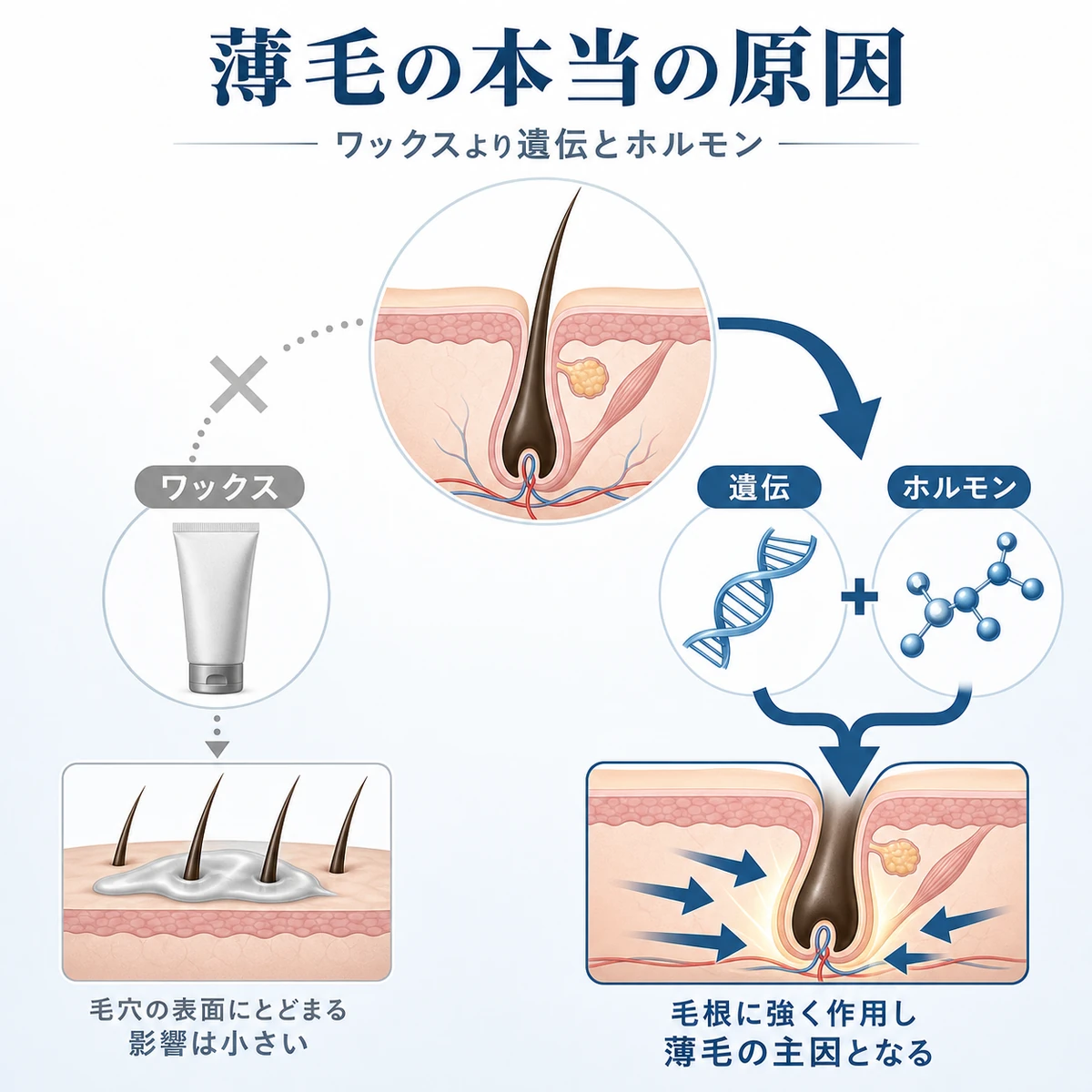 薄毛の主因が遺伝とホルモンでありワックスの影響は小さいことを表した医療イラスト