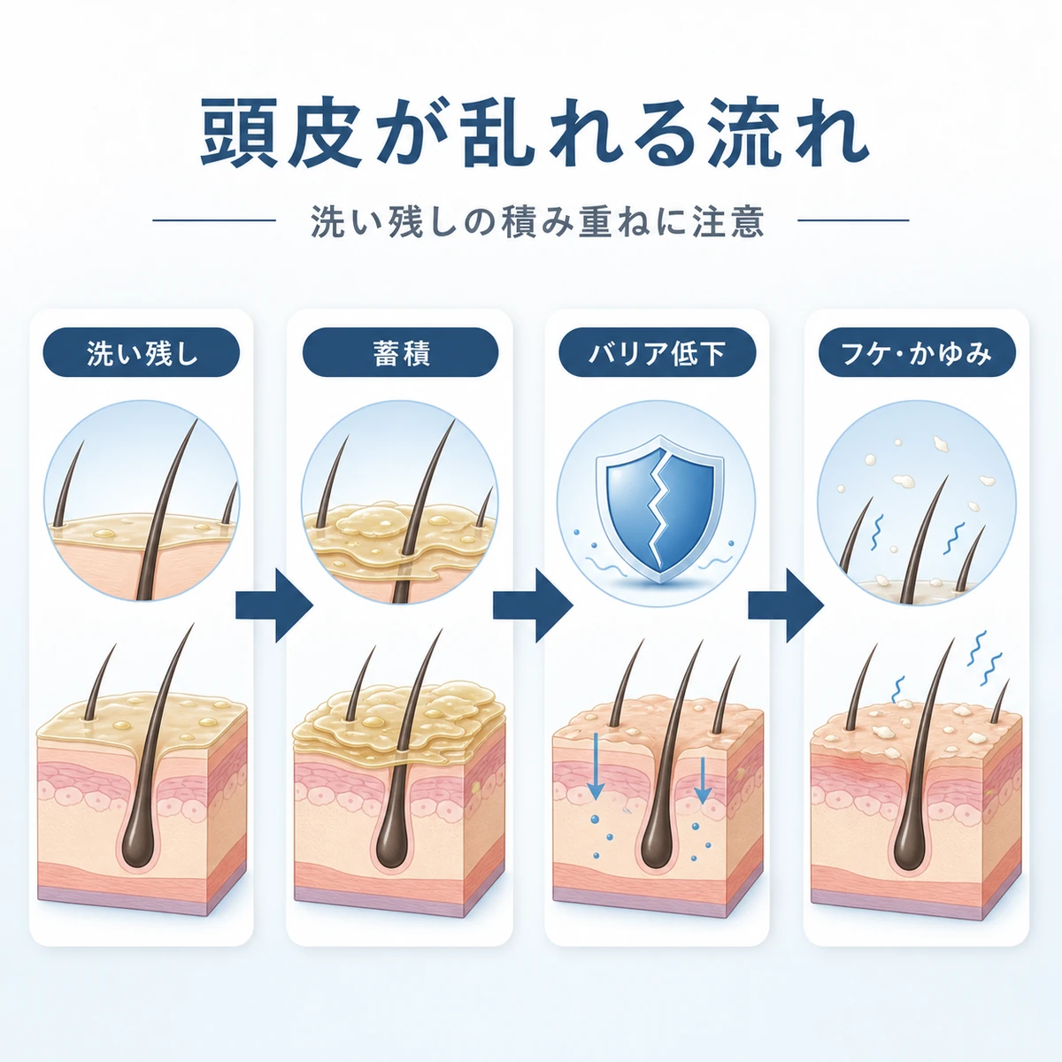 洗い残しの蓄積から頭皮のバリア低下へ進む流れを表した医療イラスト