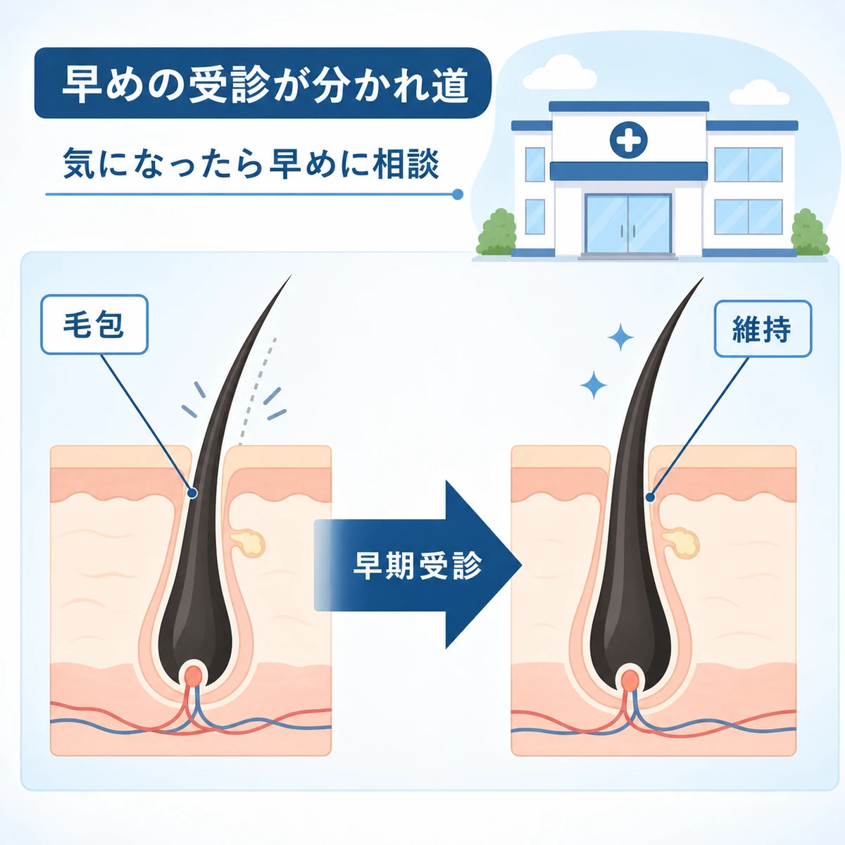 若年性AGAは早期受診で毛包の状態を保ちやすいことを表した医療イラスト