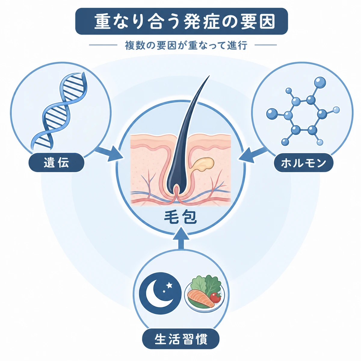 遺伝やホルモン・生活習慣が重なって若年性AGAが起こる背景を表した医療イラスト