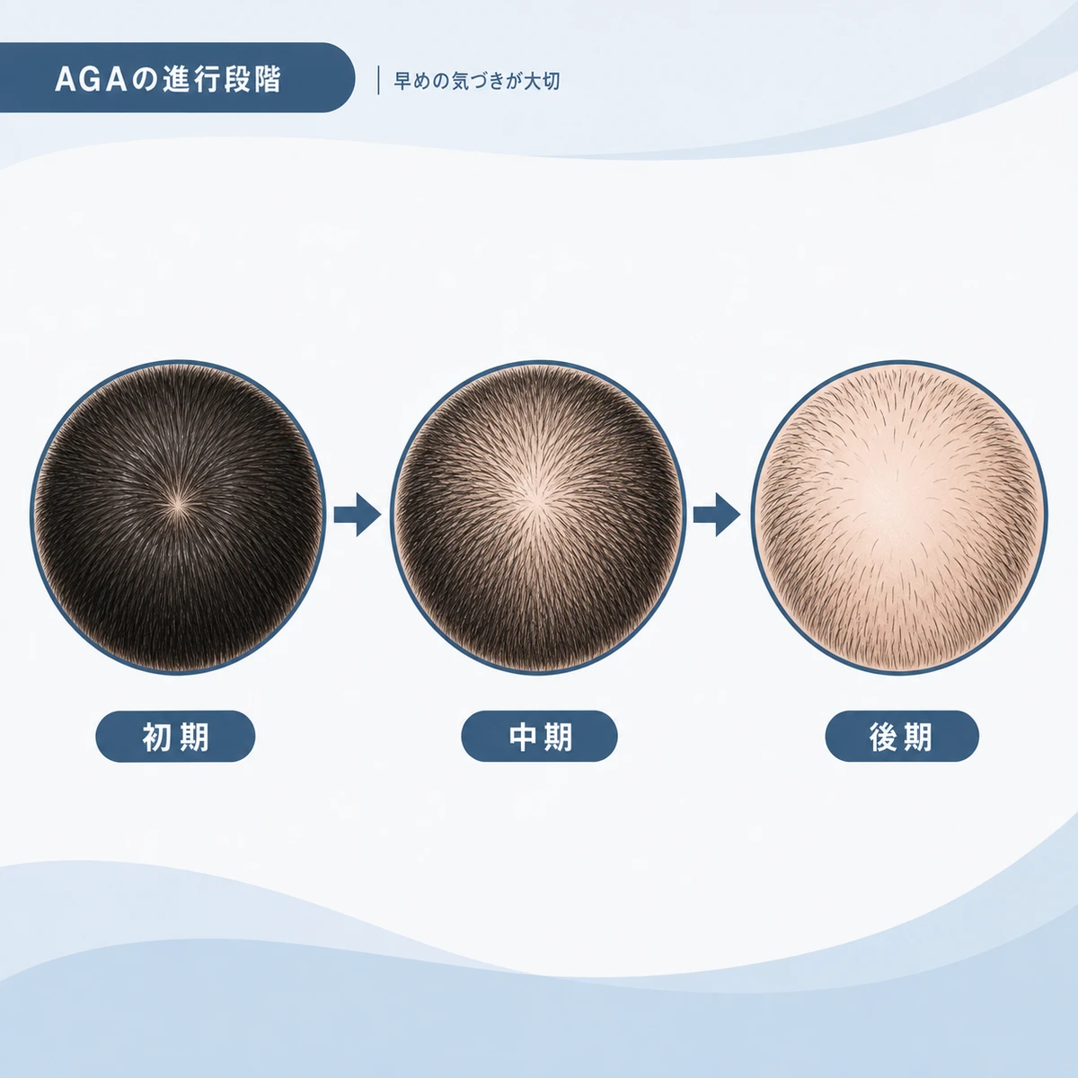 AGAが初期から後期へ段階的に進行する様子を頭皮の俯瞰図で表した医療イラスト