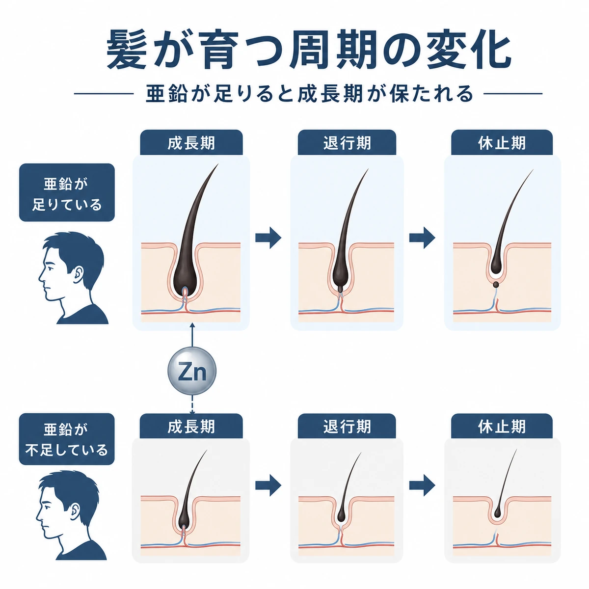 亜鉛の状態でヘアサイクルの成長期の長さが変わる様子を段階で表した医療イラスト
