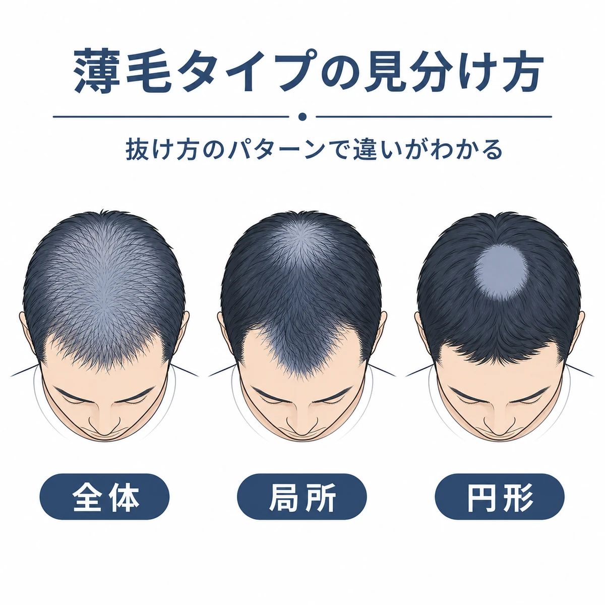 亜鉛不足による薄毛とAGAと円形脱毛症の抜け方の違いを頭部の分布で比較した医療イラスト