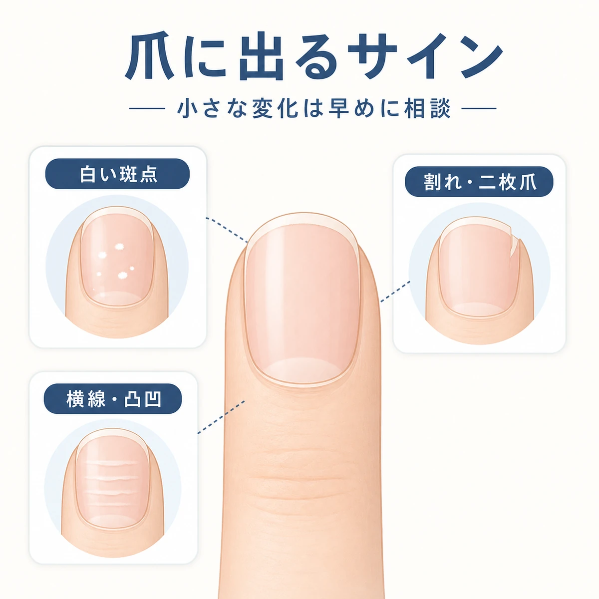 爪に現れる白い斑点や割れ、横線などの亜鉛不足のサインを分類した医療イラスト