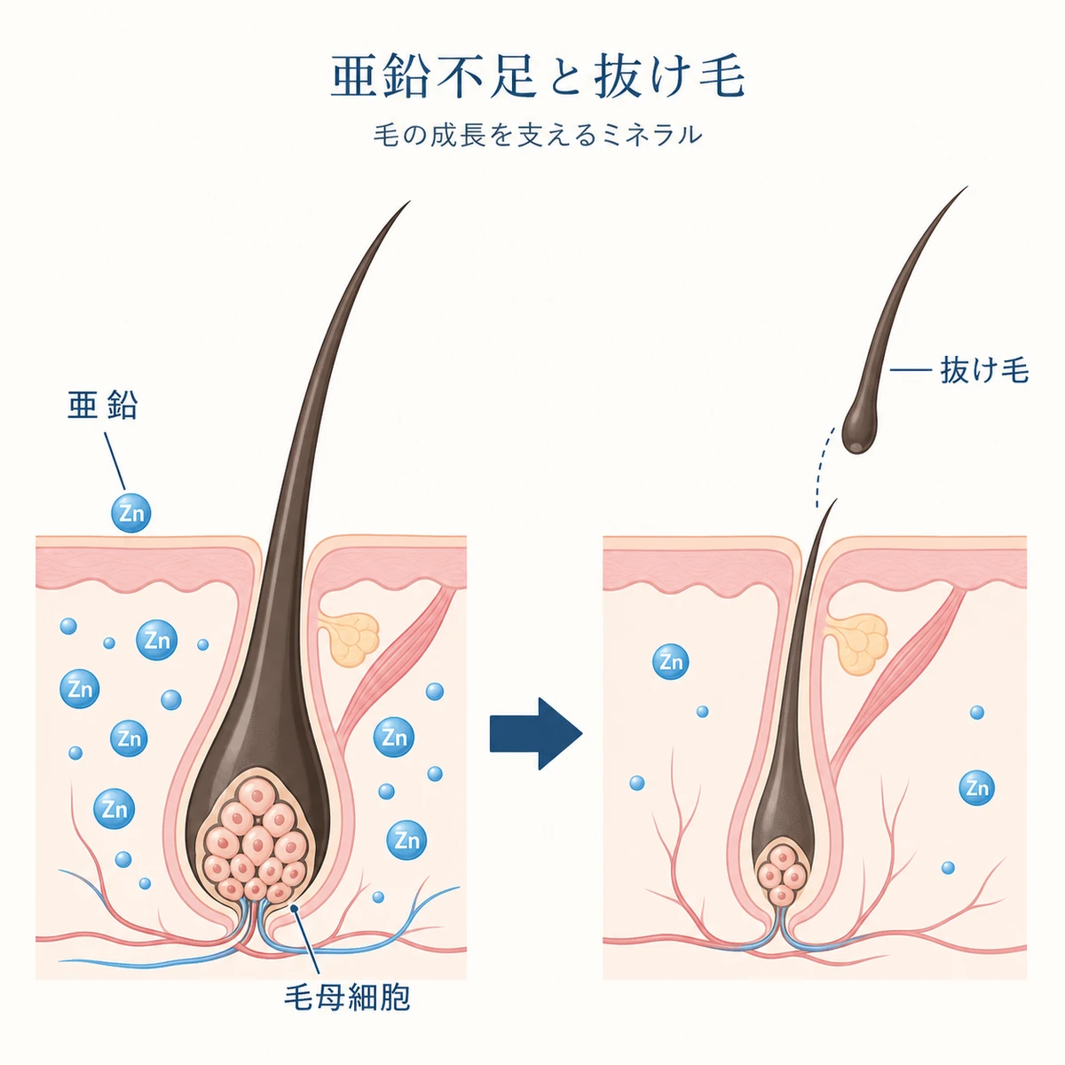 亜鉛が十分な毛根と不足した毛根を並べて抜け毛との関係を表した医療イラスト