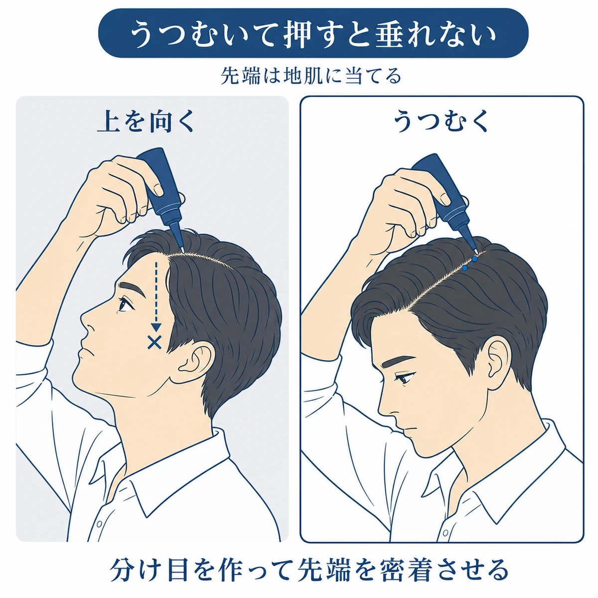 ノズル型の育毛剤を上を向いて押すと額から目へ垂れうつむいて押すと地肌にとどまることを比べた図解