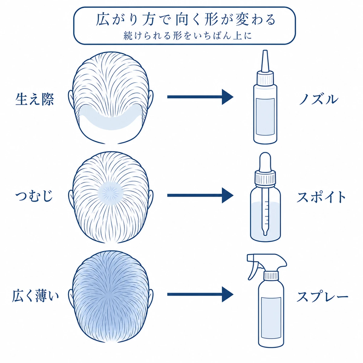生え際とつむじと広く薄い場合で向く育毛剤の容器が変わることを対応づけた図解
