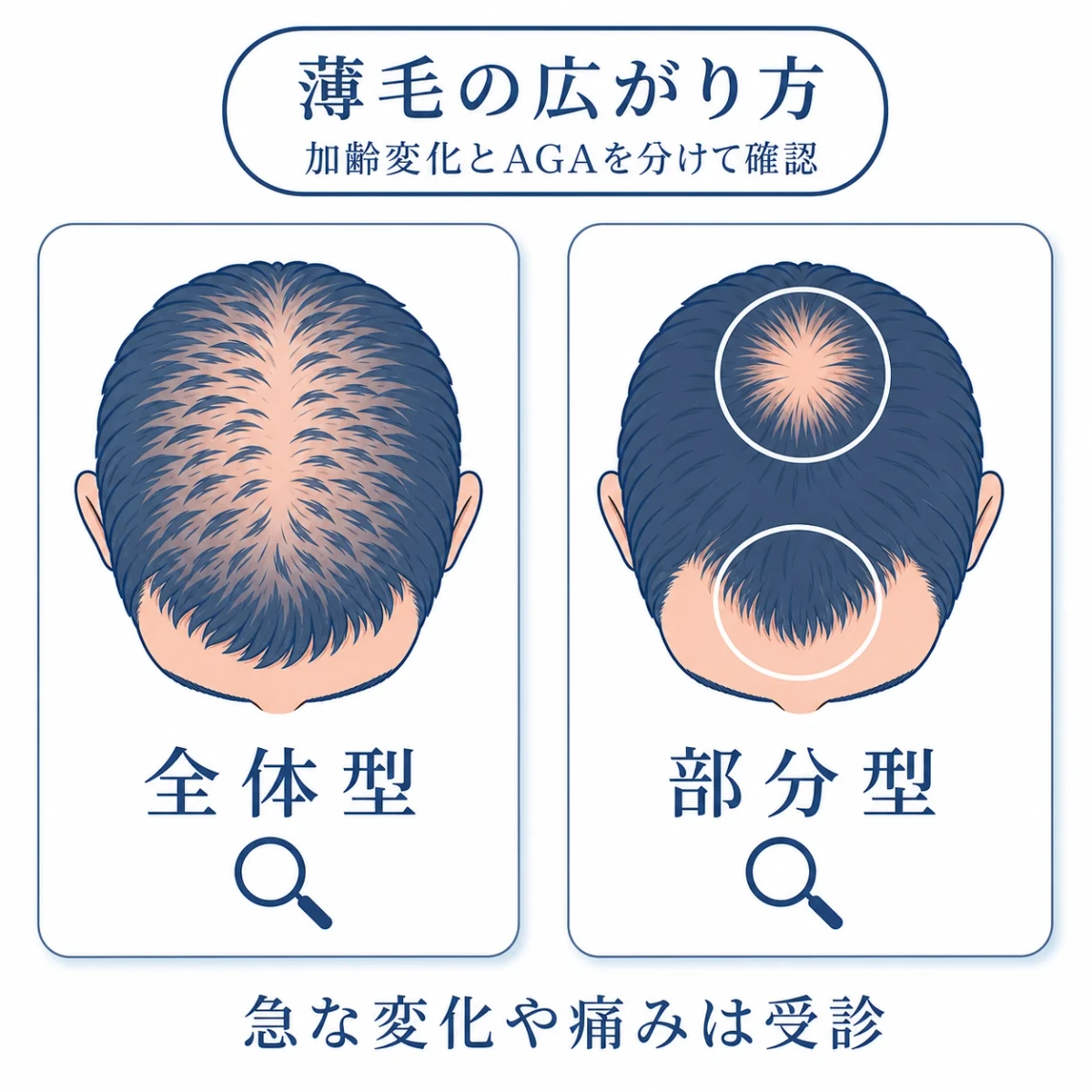 加齢性の薄毛とAGAで異なる頭部全体型と生え際・頭頂部型の広がりを比べた図解