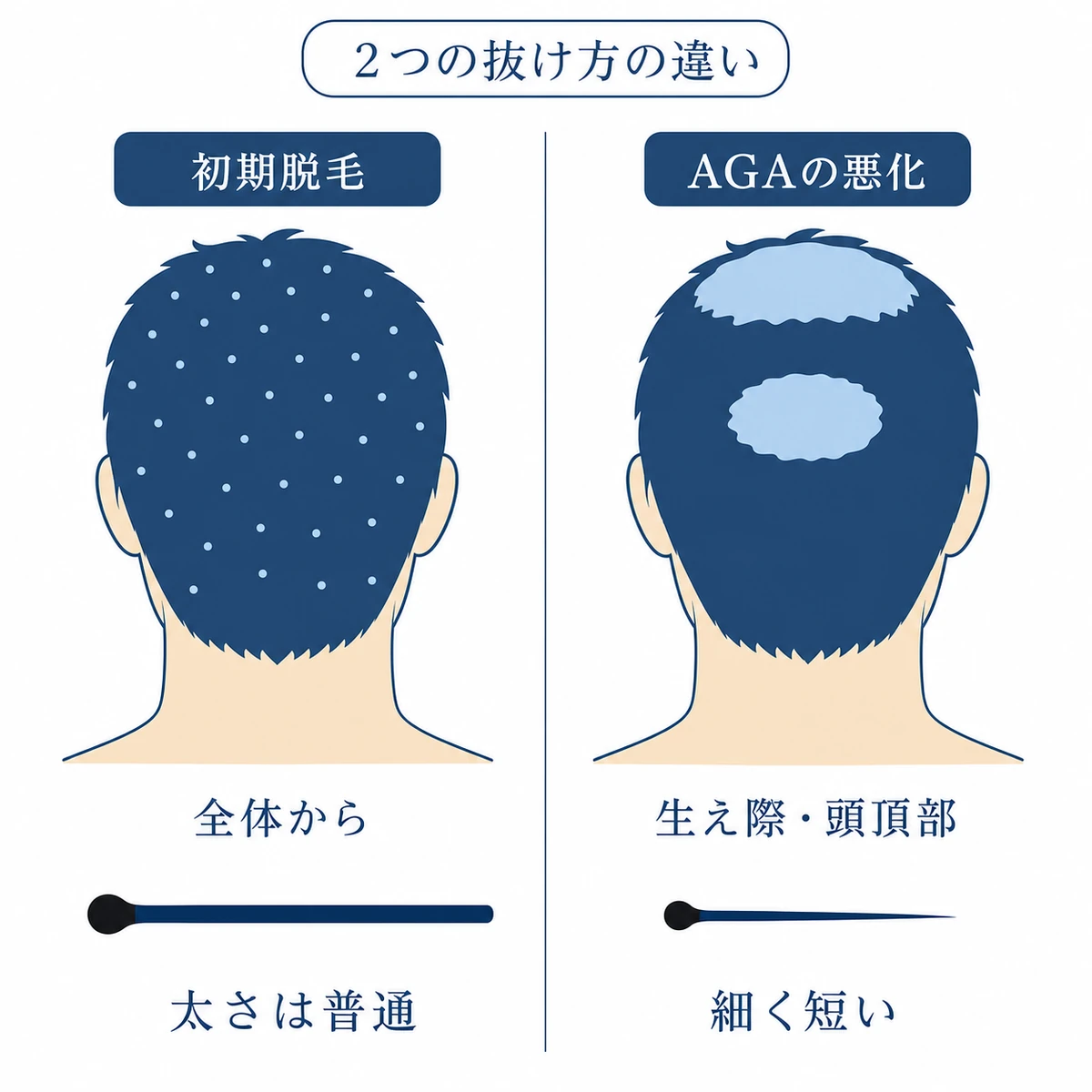 初期脱毛は頭皮全体から普通の太さの毛が抜けAGAの悪化では生え際や頭頂部から細く短い毛が抜けるという違いを並べた図解
