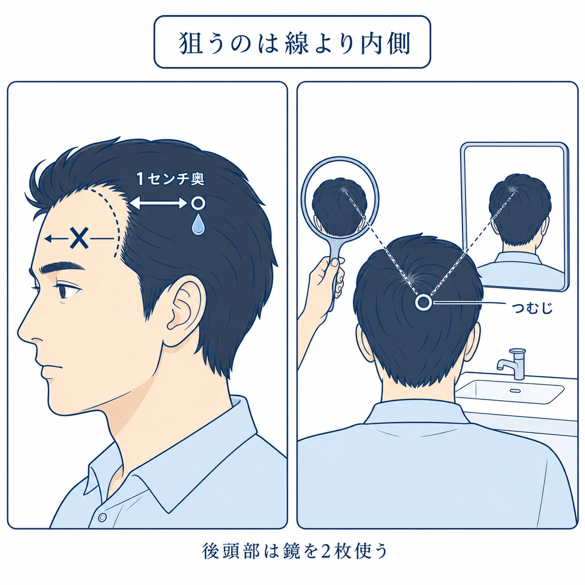 生え際は線より1センチ奥を狙いつむじは合わせ鏡で位置を確かめる塗る場所を示した図解