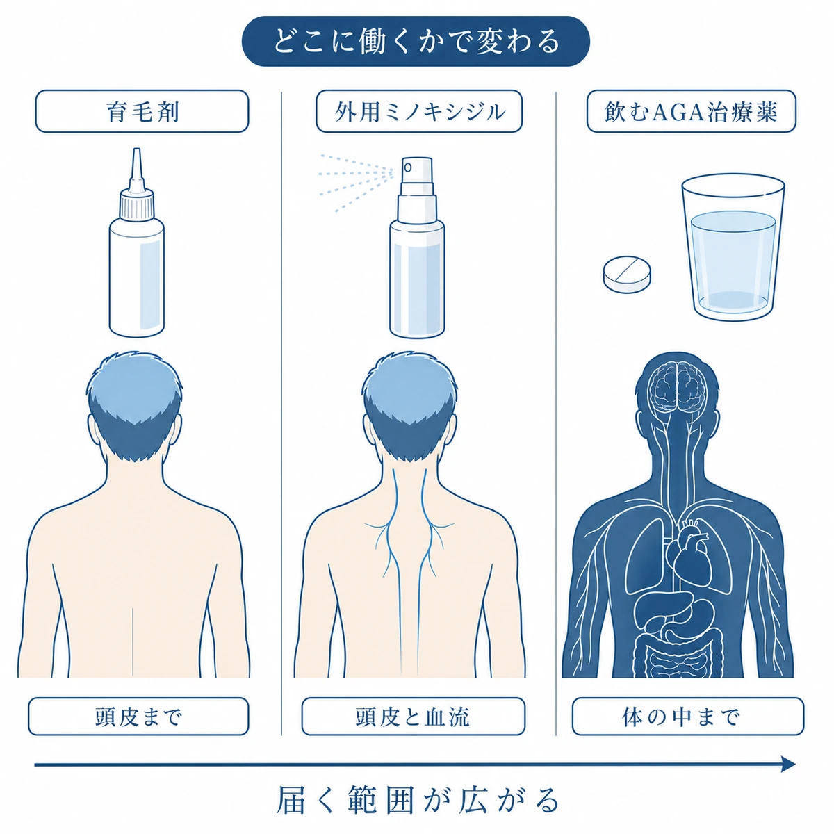 医薬部外品の育毛剤は頭皮まで外用ミノキシジルは血流まで飲むAGA治療薬は体の中まで届くという範囲の違いを3列で比べた図解