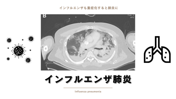 インフルエンザ肺炎（Influenza Pneumonia）