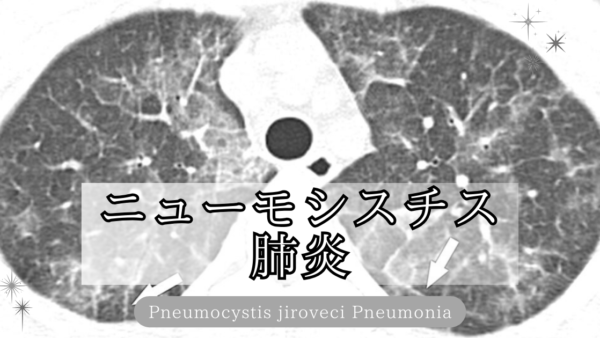 ニューモシスチス肺炎（PCP, Pneumocystis pneumonia）