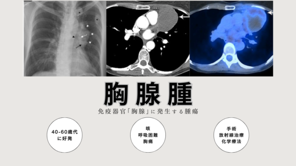 胸腺腫(きょうせんしゅ Thymoma) – 呼吸器疾患