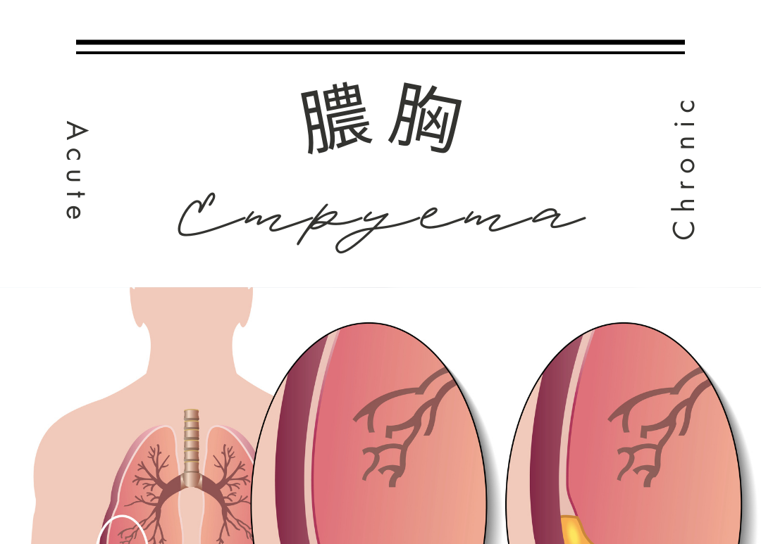 膿胸 （Empyema） – 呼吸器疾患 - 神戸きしだクリニック（神戸市