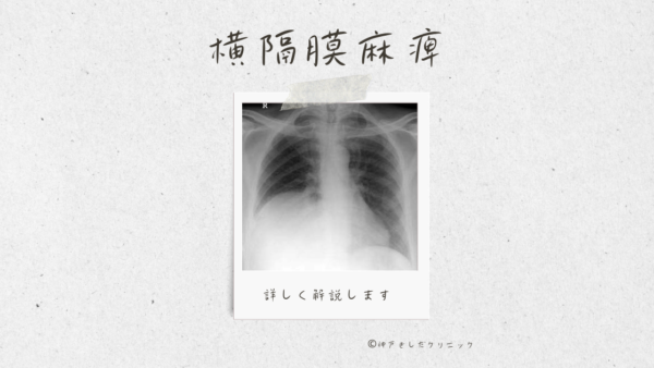 横隔膜麻痺(Diaphragmatic paralysis) – 呼吸器疾患