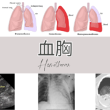 血胸(けっきょう / Hemothorax) – 呼吸器疾患