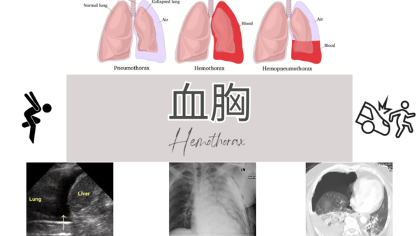 血胸(けっきょう / Hemothorax) – 呼吸器疾患