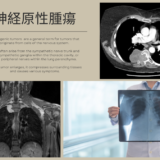 神経原性腫瘍(Neurogenic Tumor) – 呼吸器疾患