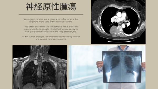 神経原性腫瘍(Neurogenic Tumor) – 呼吸器疾患