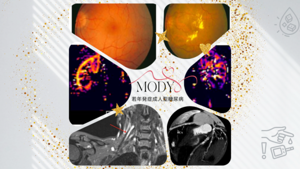 若年発症成人型糖尿病（MODY maturity onset diabetes of the young） – 代謝疾患