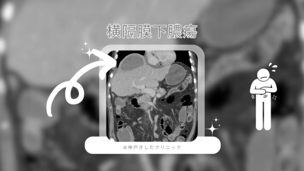 横隔膜下膿瘍(Subphrenic abscess) – 呼吸器疾患